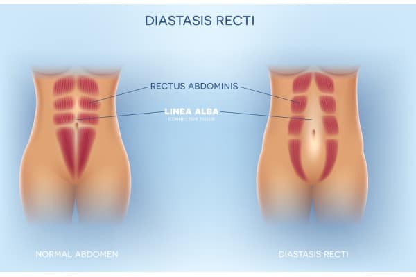 What Non-Surgical Options Are Available for Diastasis Recti Sittingbourne?