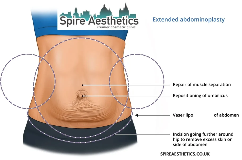 Understanding Loose Skin After Gastric Band Sittingbourne Surgery and HIFU Treatment