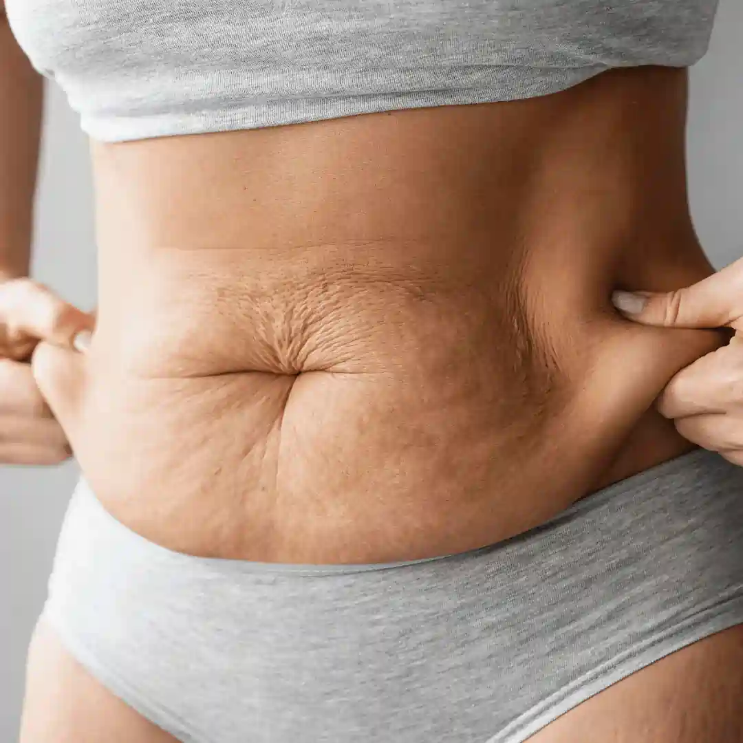 Is It Normal to Have Loose Skin After Pregnancy Sittingbourne?