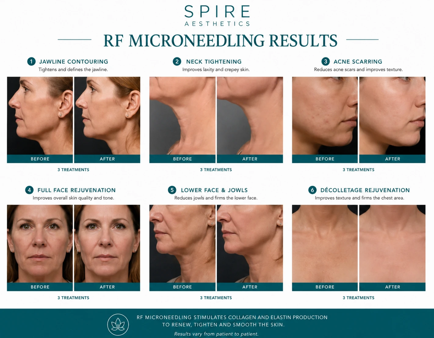 RF Microneedling Skin tightening Sittingbourne results