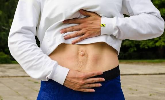 When Could Diastasis Recti Be the Missing Piece of the Puzzle Sittingbourne?