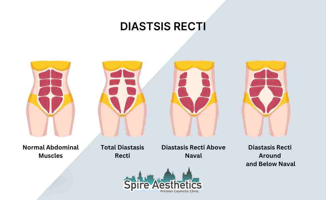 Is Non-Surgical Diastasis Recti Treatment Right for You? Common Concerns Answered Sittingbourne